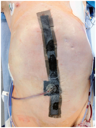 Figure 2 Examples of negative pressure wound therapy system previously shown to reduce the risk of surgical site infection.