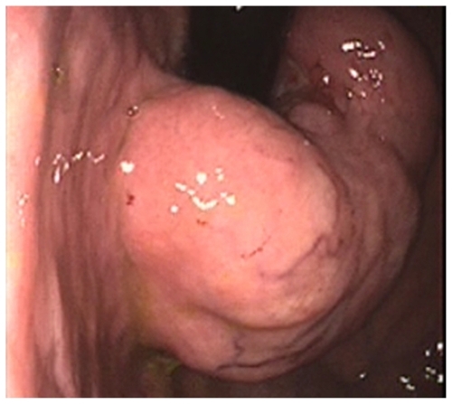 Figure 1 Retroflexed endoscopic view of a giant leiomyoma of the gastroesophageal junction.