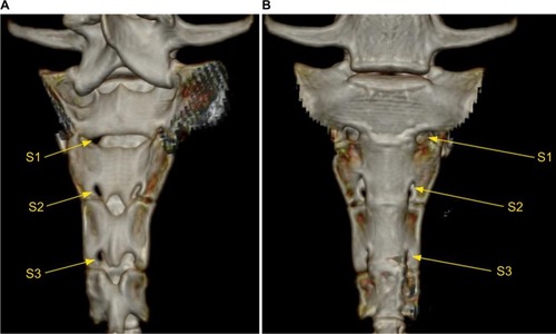 Figure 1 Bony anatomy of the sacrum displaying the neuroforamina 1–3 (S1, S2, and S3) of a minipig.