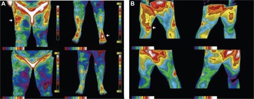 Figure 3 Reduction in inflammation with grounding or earthing documented with medical infrared imaging.Notes: Thermal imaging cameras record tiny changes in skin temperature to create a color-coded map of hot areas indicative of inflammation. Panel A shows reduction in inflammation from sleeping grounded. Medical infrared imaging shows warm and painful areas (arrows in upper part of panel A). Sleeping grounded for 4 nights resolved the pain, and the hot areas cooled. Note the significant reduction in inflammation and a return toward normal thermal symmetry. Panel B shows infrared images of a 33-year-old woman who had a gymnastics injury at age 15. The patient had a long history of chronic right knee pain, swelling, and instability, and was unable to stand for long periods. Simple actions, such as driving, increased the symptoms. She had to sleep with a pillow between her knees to decrease the pain. On-and-off medical treatment and physical therapy over the years provided minimal relief. She presented on November 17, 2004 with considerable right medial knee tenderness and a mild limp. Top images in Panel B were taken in walking position to show the inside of both knees. Arrow points to exact location of patient’s pain and shows significant inflammation. Lower images in Panel B taken 30 minutes after being grounded with an electrode patch. The patient reported a mild reduction in pain. Note significant reduction of inflammation in knee area. After 6 days of grounding, she reported a 50% reduction pain and said that she could now stand for longer periods without pain, and no longer needed to sleep with pillow between her legs. After 4 weeks of treatment, she felt good enough to play soccer, and for the first time in 15 years felt no instability and little pain. By 12 weeks, she said her pain had diminished by nearly 90% and she had no swelling. For the first time in many years, she was able waterski. The patient contacted the office after 6 months of treatment to report that she had finished a half-marathon, something she never dreamt she would ever be able to do prior to treatment.