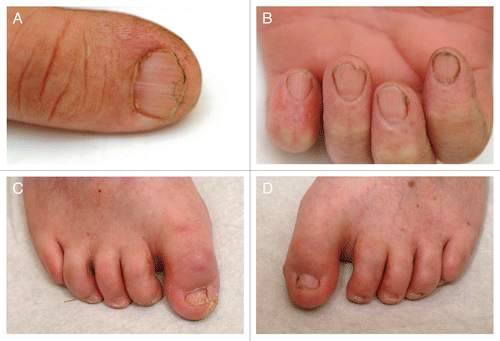 Figure 6.(A−D) Nail changes with distal nail splitting and koilonychias.