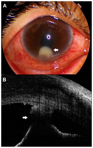 Figure 4 Horizontal scan of anterior segment SD-OCT image of a nontreated pearl-like lesion at the anterior chamber at 6 o’clock showing a highly reflective globular noncystic mass (arrow) attached to the back of the cornea and causing shadowing to the underlying iris.