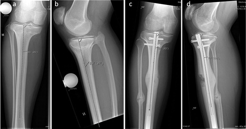 Figure 3 30-year-old man with 35 mm of tibial shortening due to traumatic injury to the proximal tibial growth plate in childhood. Furthermore, the patient had a symptomatic high-riding fibular head (a). Initial PPTA was slightly below normal (b). The patient was lengthened with a tibia Precice® nail. The fibula was osteomized, but transfixation was done only between the tibia and fibula distally to the osteotomy. This resulted in some lengthening of the fibula as well as an intended distalization of the fibular head (c). However, PPTA increased slightly from preoperatively, which was not intended (d). Delayed healing of the regenerate anteriorly (d). However, there was solid callus on 3 cortices (c, d).