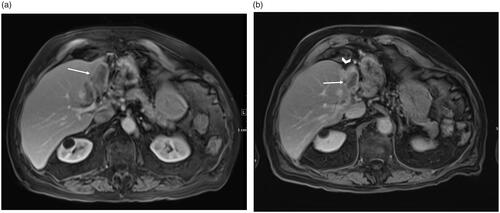Figure 2. A 86 year-old male CRC patient with metastatic lesion in the left lobe (a) Pretreatment MRI showing baseline low-attenuation lesion in segment II/III measuring 6.3 × 3.2 cm (arrow). Radiation segmentectomy was performed for the patient and a dose of 235 Gy was administered. (b) MRI at one-year follow-up shows a shrunken non-enhancing tumor (3.6 × 1.9 cm, arrow) with retraction and atrophy of the treated segments (arrowhead).