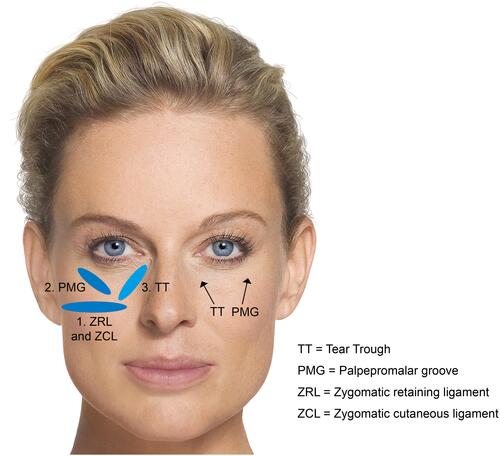 Figure 5 Treatment of the infraorbital hollows. Image courtesy from Merz Pharmaceutical GmbH.
