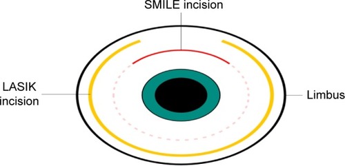 Figure 1 Schematic representation of SMILE incision and LASIK flap incision with respect to the corneal limbus.