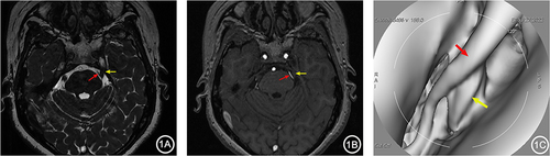 Figure 1 A 50-year-old female with left TN for 3 years. 3D-FIESTA-c axial (A) and 3D-TOF-MRA axial (B) showed vascular contact (red arrow) at the left trigeminal nerve (yellow arrow). MRVE image (C) showed the left Superior Cerebellar Artery (red arrow) compressing the trigeminal nerve from above (yellow arrow).