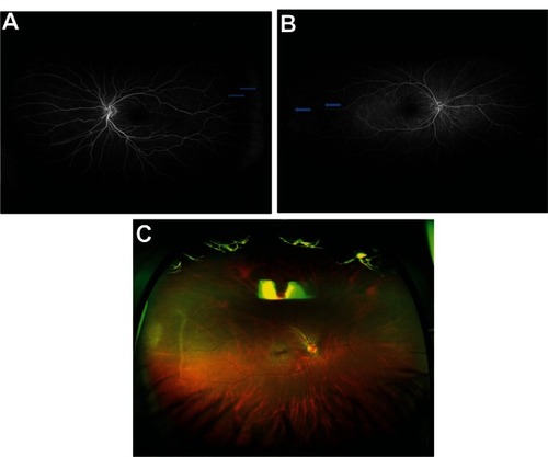 Figure 4 (A and B) Ultra-widefield fluorescein angiography pattern two. (C) Color photo corresponding to Figure 4B (ultra-widefield fluorescein angiography pattern two).