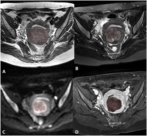 Figure 3. The measurement of VT2WI, VDWI, NPV and volume of adenomyosis. A. Measurement of volume of adenomyosis on pretreatment T2WI; B. Measurement of VT2WI on post-treatment T2WI; C. Measurement of VDWI on post-treatment DWI; D. Measurement of NPV on post-treatment CE-T1WI.