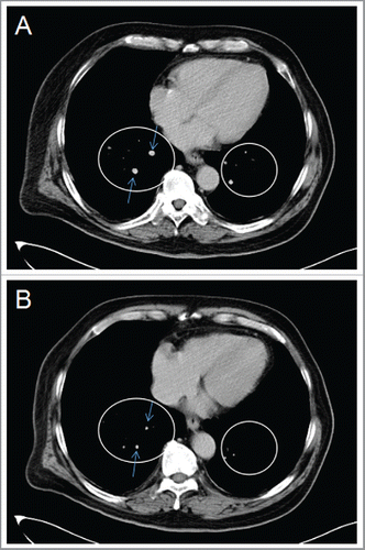 Figure 4. CT images of a 55-year-old man with bilateral pulmonary metastasis who underwent 4 courses of HANK cell immunotherapy. The circular area and blue arrows in panels (A) and (B) indicate the tumors. (A) Contrast-enhanced CT scan taken in the venous phase showing 2 lung multiple metastatic tumors (circular areas), with the larger tumor having a diameter of more than 0.5 cm (blue arrows). (B) Contrast-enhanced CT scan taken at 3 months after NK cell immunotherapy showing decrease in pulmonary metastasis (circular area) and a decrease in the diameter of the larger tumor to about 0.3 cm (blue arrows).