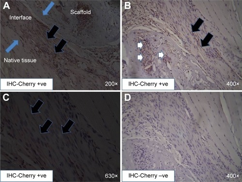 Figure 6 Identification of donor MDCs in retrieved engineered muscles repaired with TEMR–MDC constructs.Notes: Lentivirus expressing Cherry reporter was transduced into MDCs prior to seeding on to BAM scaffolds. TEMR-lenti-Cherry-MDC (n=8)-implanted engineered muscles were retrieved 2 months postrepair and processed for paraffin embedding. Immunohistochemistry (IHC) staining was performed on sections with anti-Cherry antibody. A depicts an overview of IHC cherry positive staining at the interface (demarcated by blue arrows) of native tissue and scaffold. Newly regenerating, differentiating, and elongated myofibers incorporating donor MDCs could be detected at low (A) or high magnification (B and C), indicated by black arrows; scaffold also displayed unfused donor MDCs, as indicated by white arrows (B). Negative controls (D) from adjacent sections were displayed to confirm the specificity of anti-Cherry antibody staining. IHC-Cherry −ve, negative control, done by omitting primary (Cherry) antibody; IHC-Cherry +ve, positive staining obtained upon using primary (Cherry) antibody. IHC-Cherry −ve and IHC-Cherry +ve indicate color development by IHC is specific, ie, there is no color development in the absence of primary antibody.Abbreviations: MDC, muscle-derived progenitor cell; TEMR, tissue engineered muscle repair; BAM, bladder acellular matrix; TEMR-lenti-Cherry-MDC, tissue engineered muscle repair construct created with seeding MDCs that were labeled with lentivirally expressing Cherry reporter; IHC, immunohistochemistry.