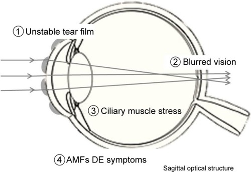 Figure 4 The mechanism of occurrence of dry eye symptoms. Image defocus due to tear instability represents visual impairment.