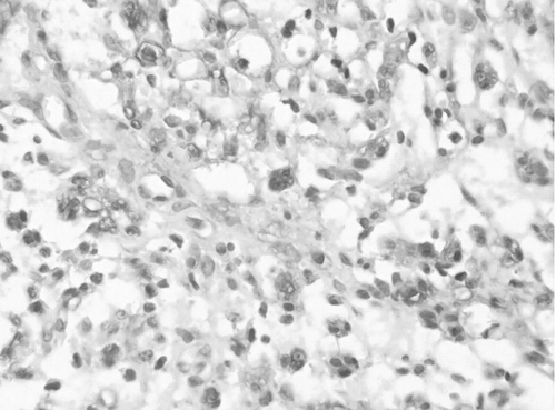 Figure 1 Expression of Schwann cell S100 on the suture side at 14th day, immunohistological stain X400.