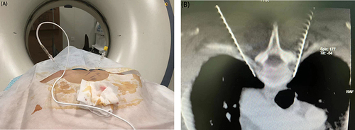 Figure 1 (A–B): The puncture needle reaches the puncture target according to the designed path.