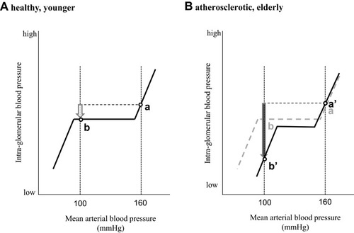 Figure 2 Hypothetical mean arterial blood pressure (BP) and intra-glomerular BP curves when using RAS inhibitors. In the absence of arteriosclerosis, if the mean systemic arterial pressure drops from (A) 160 mmHg to (B) 80 mmHg, the decrease in glomerular pressure is small (white arrow). However, if the atherosclerotic change is severe, there would be an insufficient increase in glomerular pressure due to dilation of efferent arterioles induced by RAS inhibitors, and the mean arterial pressure decreases rapidly (a’ to b’), causing glomerular pressure to drop sharply (black arrow).