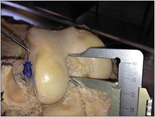 Figure 8. Height from the guidewire to the intercondylar roof.Source: Anatomy Laboratory–UNIRIO, 2014–2015.