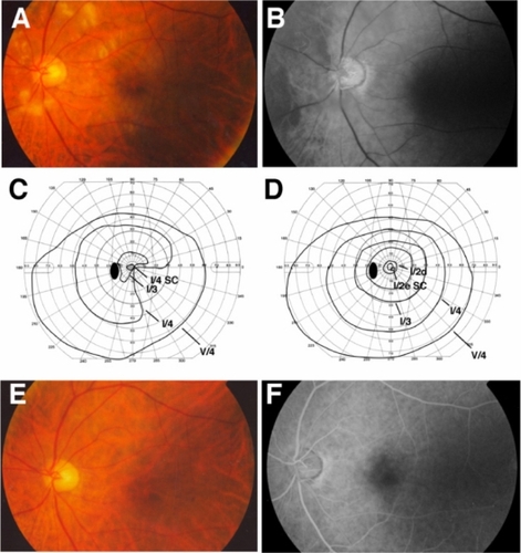 Figure 3 Clinical findings for Case 3. Fundus photographs and fluorescein angiograms before treatment. There are many cotton wool patches surrounding the optic disc and slight retinal whitening surrounding the fovea (A). Fluorescein angiography showing that nonperfused areas of the retinal arterioles were found in the areas corresponding to the cotton wool patches. The delay in choroidal filling in the nasal area and arm-to-retina time (28 seconds) were found (B). Goldmann kinetic perimetry before (C) and 6 weeks after (D) treatment. There is a central scotoma and a constriction in lower nasal field and paracentral scotoma before treatment (C). Central scotoma is decreased and the constriction of lower nasal field has abated after treatment (D). Fundus photograph (C) and fluorescein angiogram (D) 6 weeks after treatment. Cotton wool patches are not present and optic disc is slightly pale (E). Fluorescein angiography showed improvement of retinal circulation 38 seconds after the injection of fluorescein (D).