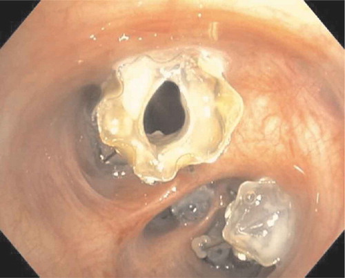 Figure 4. Malfunction of EBV due to mucus impaction. The valve mechanism is compromised and constant flow over the valve prevents target lobe volume reduction