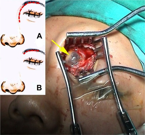 Figure 5 FS surgery through an extranasal approach.