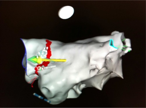 Figure 6 Integration of the Carto 3 RMN system with the Navigant system, which enables instantaneous navigation along with visualization of both the Navistar RMN catheter and the lasso.
