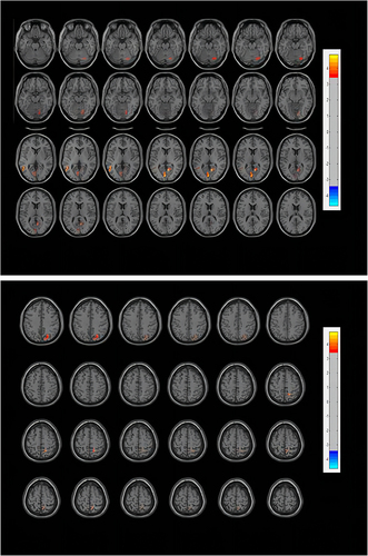 Figure 1 Functional connectivity differences of the LC between CID patients and healthy controls. The threshold of the color bar means the T value. The warm color (right precuneus, right posterior cingulate cortex, left middle temporal gyrus, left calcarine, right superior orbitofrontal cortex) represent increased connectivity.