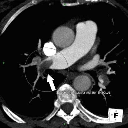 Figure 4 Patient presenting with acute chest pain; CCTA image showing large right pulmonary artery embolism.