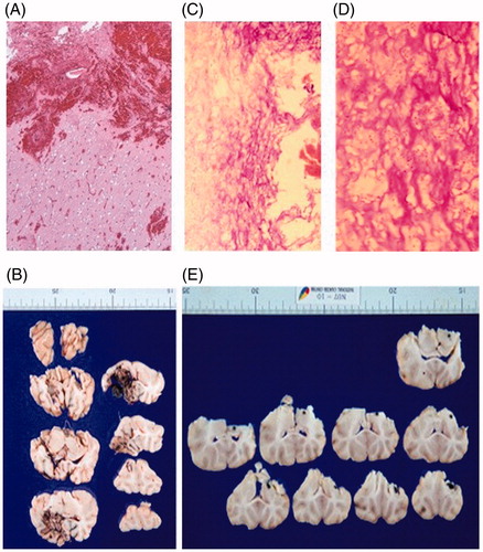 Figure 4. Pathology studies performed on pigs during the pre-clinical animal experiment. (A) Hematoxylin & Eosin (H&E) stain and (B) formalin fixed brain slices of a pig that was terminated immediately after the hyperthermia treatment. Hemorrhage and mild edematous change around the surgical cavity was observed. However, heat-induced degenerative neuronal injury was not observed. (C) H&E stain 40 × (D) H&E stain 100× and (E) formalin fixed brain slices of a pig that was terminated one month after the hyperthermia treatment. Pyknosis and cytoplasmic degeneration surrounded by foam cells and inflammatory cells were observed. Reactive gliosis was observed in the adjacent brain tissues but heat-induced degenerative neuronal injury was not observed.