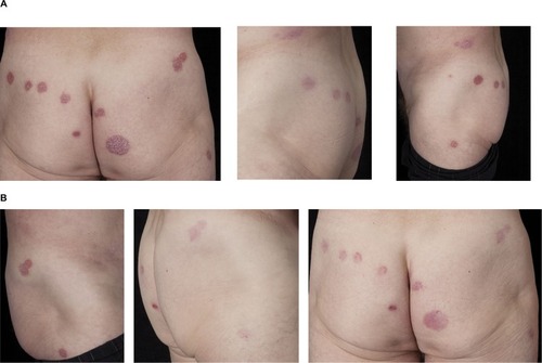 Figure 1 (A) Recalcitrant psoriasis on the lower trunk and gluteal regions of a 72-year-old male before treatment with Cal/BD aerosol foam. (B) Psoriatic lesions after 4 weeks’ treatment with Cal/BD aerosol foam.