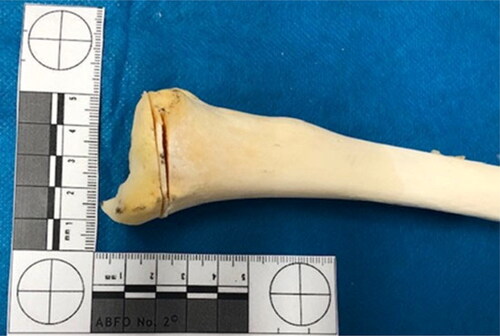 Figure 11. Distal epiphysis of the left tibia showed injuries consistent with false starts.