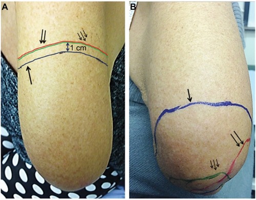 Figure 5 Amputation stump hypersensitivity in a patient before (A) and after (B) capsaicin 8% patch treatment.