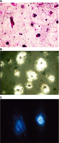 Figure 6 Microcomedones collected on CSSS from the face.