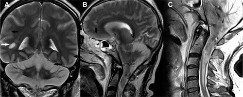 Figure 2 Unenhanced T2-weighted coronal (A) and sagittal (B) images of the brain and cervical spinal cord (C) showing hyperintensities involving the cerebellar cortex and brainstem (solid black arrows). A focal hyperintense lesion is noted in the right temporal periventricular white matter (solid white arrow). Petechial hemorrhages are noted in the brainstem (open black arrows). The cervical spinal cord is swollen and reveals hyperintense signals within it (open white arrow).