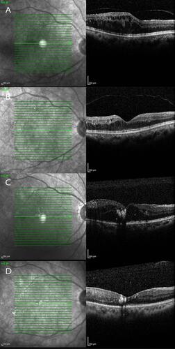 Figure 1 The examples of patient ocular tomography.Notes: A) is group A pre-treatment; B) is group A post treatment; C) is group B pre-treatment; D) is group B post treatment.