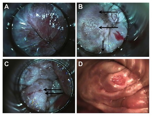 Figure 1 High-resolution anoscopy appearance of anal epithelium. (A) Normal and (B) vascular patterns of high-grade dysplasia; upper arrow points to fine irregular punctation, middle arrow points to coarse irregular punctation, lower arrow points to prominent and dilated linear vessels. Biopsies of all three areas were AIN-3. (C) Vascular patterns of high-grade dysplasia. Arrows point to mosaic pattern with punctation in the middle of the mosaic tiles. Biopsy showed squamous cell cancer in situ. (D) Surface findings of high-grade dysplasia include ulceration. Biopsy showed AIN-3.