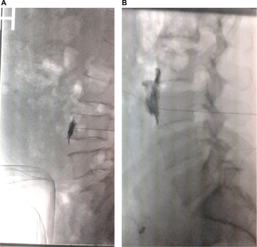 Figure 2 Fluoroscopic view of lumbar sympathetic block right after the injection of the contrast (A) and the dissemination of contrast material (B).
