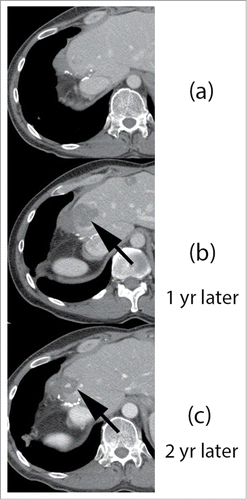 Figure 3. Response of hepatic lesions to treatment with FOLFIRI plus panitumumab, and Y-90 intrahepatic radioembolization.