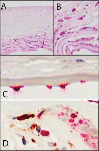 FIGURE 1. Immunohistochemistry on corneal tissue removed during penetrating keratoplasy from patients with CMV graft infection. (A,B) Histology (hematoxylin and eosin stain 20×, 40×): Viral cytopathic changes are characterized by cellular enlargement (up to 2 times a normal keratocyte) with eosinophilic intranuclear and intracytoplasmic inclusions. Note the significant lack of inflammation and vascularisation as seen in other herpetic keratitis. (C) CMV immunohistochemistry, 40× (Dako, USA with alkaline phosphatase red chromagen) demonstrating CMV antibody staining in the endothelial cells confirming the presence of CMV endotheliitis. (D) Dual CMV and CD163 macrophage (Dako, USA) immunohistochemistry (40×) with alkaline phosphatase red chromagen, CMV antibody, and brown diaminobenzidine staining for CD163 shows no colocaliztion of CD163 with CMV demonstrating that CMV is not latent in macrophages.