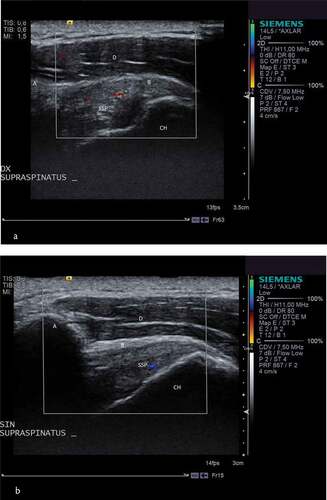 Figure 4. A and b. Ultrasound of both shoulders in a 42 year old male patient with unilateral subacromial pain syndrome.