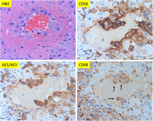 Figure 1. Morphologic features of maternal spiral artery remodeling in early implantation site with immunohistochemical staining for CD56, pancytokeratin (AE1/AE3) and CD68 expression. (A) Implantation site of early missed abortion with hematoxylin & eosin (H&E) stain. (B–D) The same section of implantation site as panel A with CD56, AE1/AE3 and CD68 immunostaining. (A–D at 400× magnification). Arrow indicates weak CD68 reactivity.