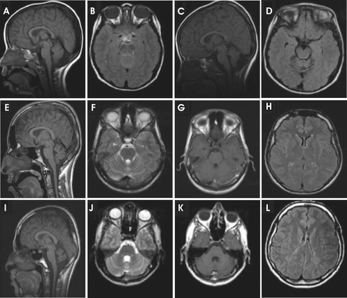 Figure 3.  Reduction in cerebellar volume of Saudi Arabian patients with a mutation in CA8 gene (Gln162-Arg). The brain magnetic resonance imaging (MRI) of the (A–D) patient 1, (E–H) patient 2, and the (I–L) patient 3. Figures show the progressive cerebellar loss in patient 1 between the sagittal T1 (A and C) and axial flair images (B and D) in the scans performed at 4 (A and B) and 8 years of age (C, D), respectively. Sagittal T1 images (E and I) show reduction in cerebellar volume more prominent in patient 3 (I) than in patient 2 (E). The volume loss is not associated with parenchymal signal abnormality as evident in images F, G, J, and K. Small sella turcica and skull base fatty replacement are also shown (E and I). Axial flair images (H and L) demonstrate deep periventricular white matter abnormalities with more involvement seen in patient 3 (L). Modified from Kaya et al.Citation7