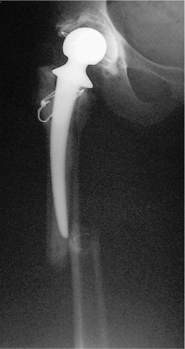 Figure 1. Vancouver type B2 fracture. The stem was unstable and was revised, whereas the quality of the surrounding bone was good.