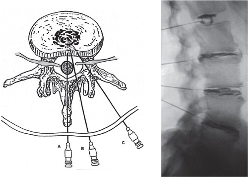 Figure 3. Provocative discography is performed under sterile conditions and with biplanar fluoroscopic control. The intended disc space is injected with contrast agent to provoke usual back pain. In addition, the amount of degeneration can be visualized on plain radiographs or CT scan.