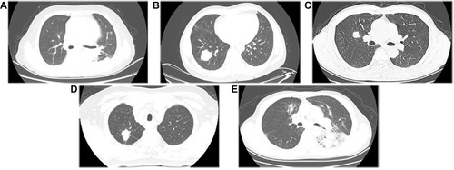Figure 1 The five types of tumor margin as seen on the CT images.Note: (A) smooth; (B) lobulated; (C) spiculated; (D) angular; (E) obscured.Abbreviation: CT, computed tomography.