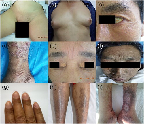 Figure 3. Hair, hormonal and other dermatologic manifestations in patients with chronic liver disease. (a) Loss of pubic hair, (b) gynaecomastia, (c) jaundice, (d) prurigo nodularis, (e) xanthelasmas, (f–h) pigmentation, (i) leg ulcer.