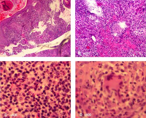 Figure 3 Pathological manifestation showed an infectious granuloma with various infiltrating cells in the dermis (A and B), including neutrophils, lymphocytes, plasmid cells, (C) epithelioid cells, and monocytes and macrophages (D). No hyphae or satellite bodies were observed.