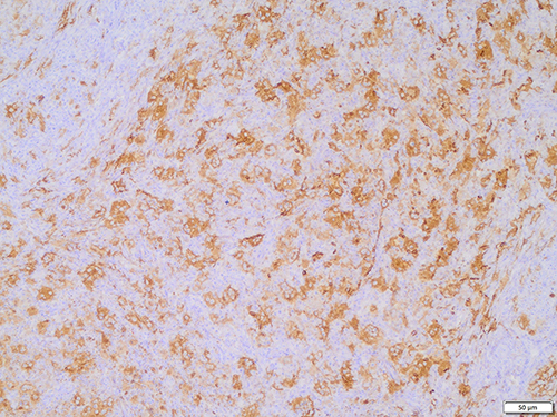 Figure 7 Positive for S100 in the histiocytes. The En Vision two-step method.