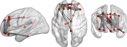 Figure 4 Three-dimensioned views by BrainNet Viewer; respectively, sagittal, axial, and coronal view, showing the same nodes as in Figure 3.