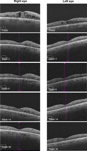 Figure 8 Data from patient number 3 showing OCT scans at pre- and postop visits.