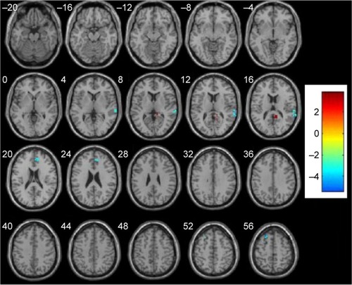 Figure 3 Altered resting-state FC in the DMN in schizophrenia patients before and after treatment.