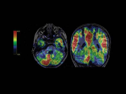 Figure 2. Color-code perfusion map with the pulsed-ASL sequence. Decreased cortical blood flow in the patient´s left cerebellar hemisphere.